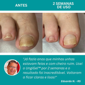 Adesivo antifúngico para unhas - Nail Shield™