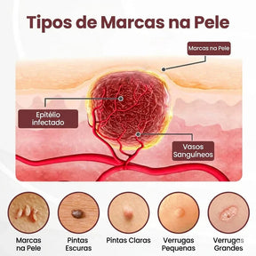 Adeus Verrugas: Creme VERRUE [COMPRE 1 LEVE 2] + Frete Grátis